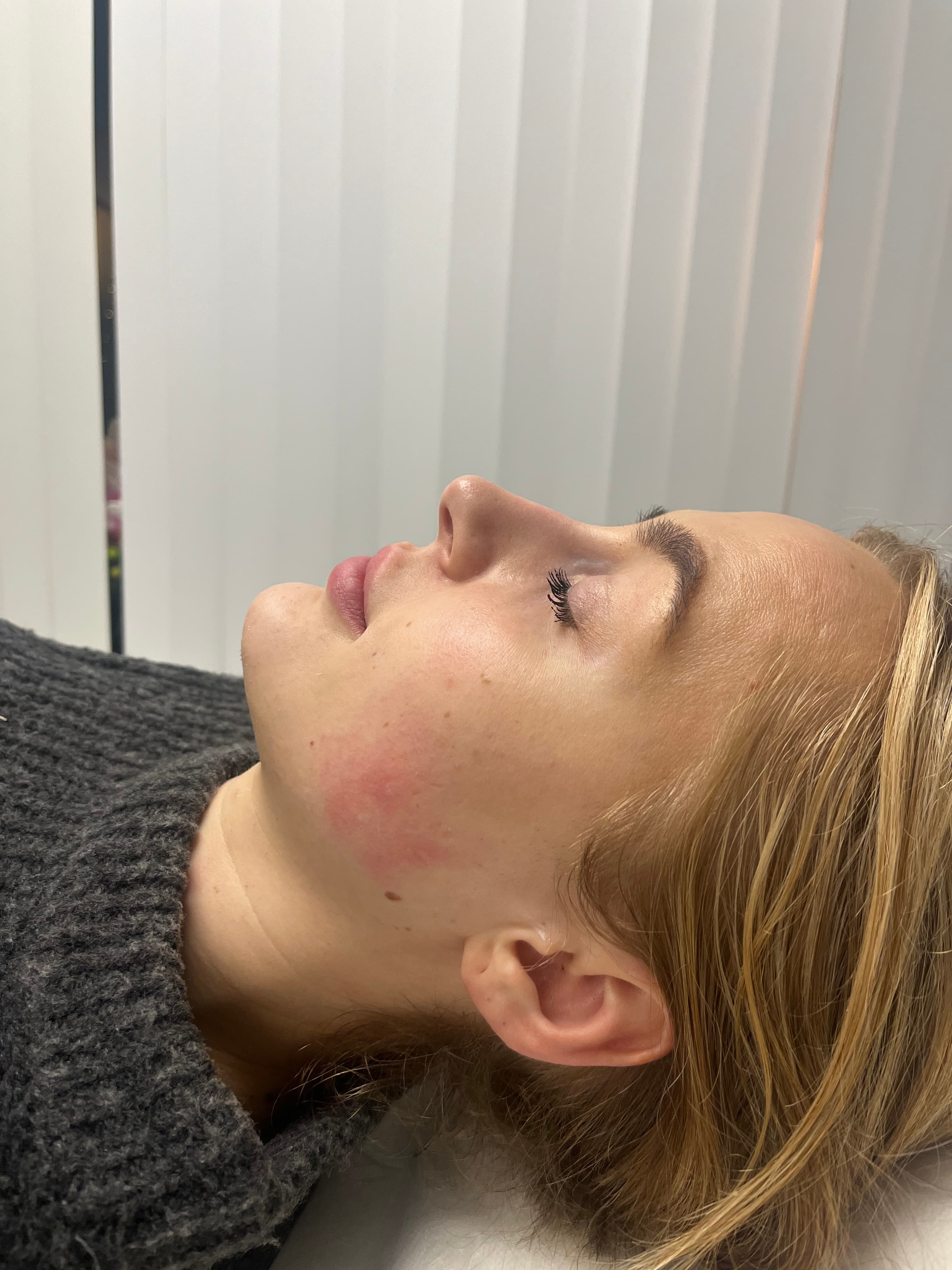 Lugn estetisk botoxbehandling — naturligt resultat på Cherry On Top Clinic i Sollentuna.