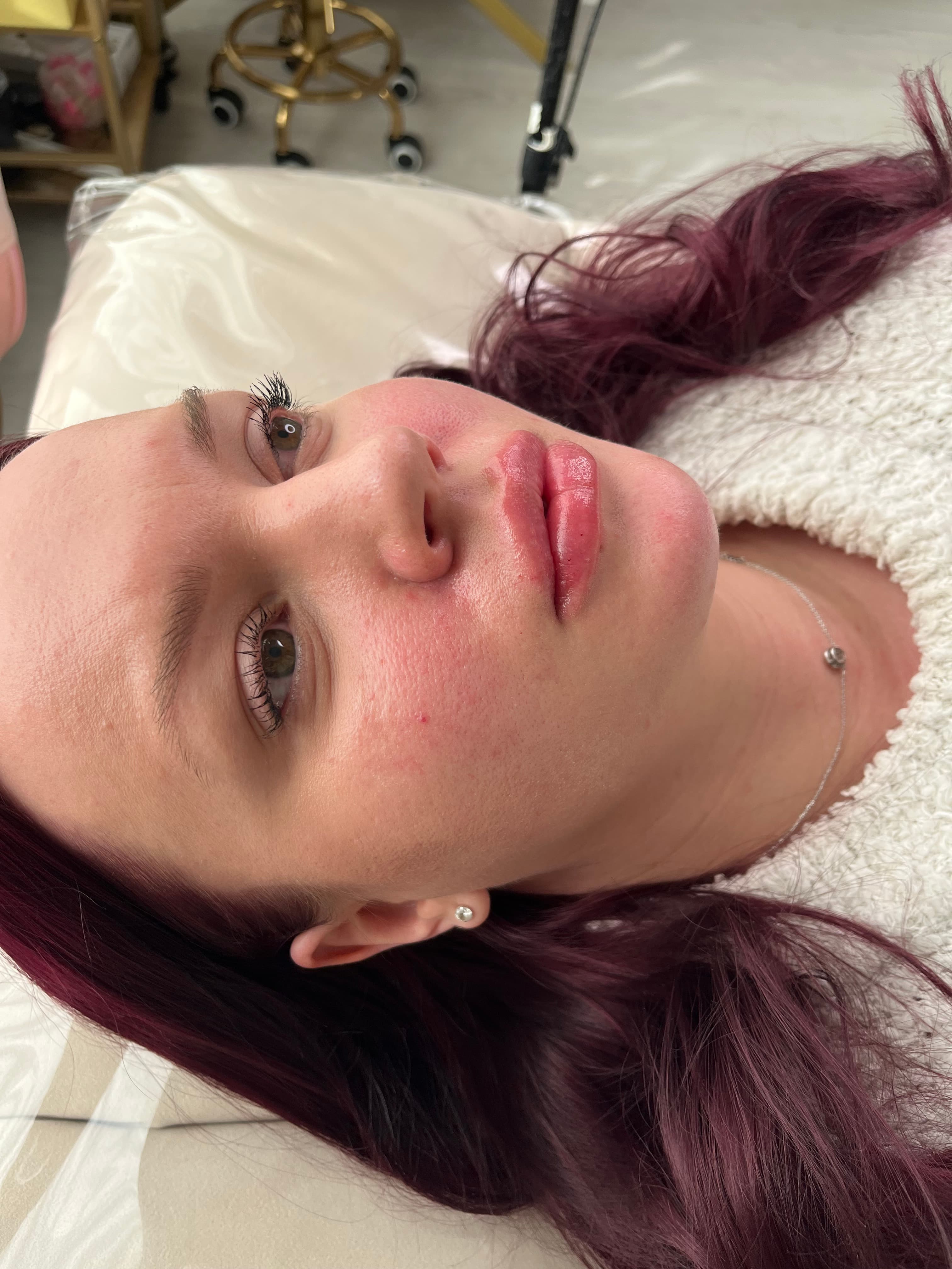 Naturligt resultat efter läppfiller på Cherry On Top Clinic i Sollentuna.