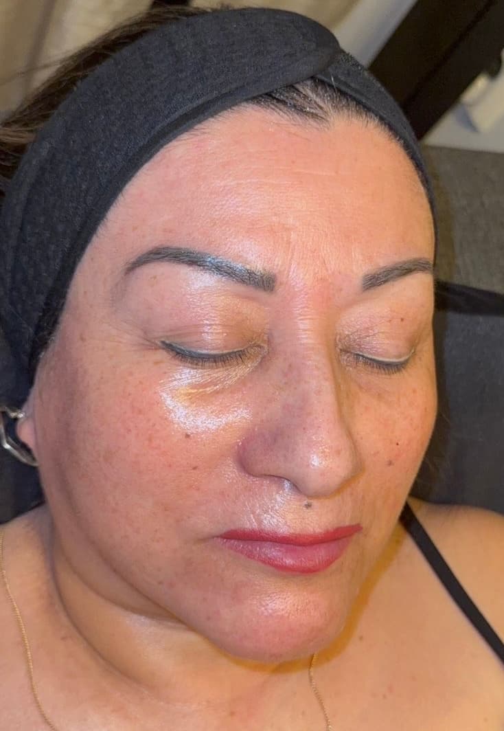 Frisk, fuktbalanserad hud efter skinbooster-behandling på Cherry On Top Clinic i Sollentuna.